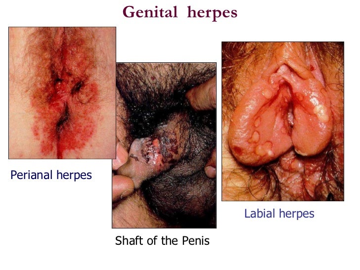 herpes pictures on shaft of penis Julianne huff naked